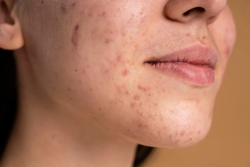 Acne Scars: Causes, Treatment Options, and What Results to Expect