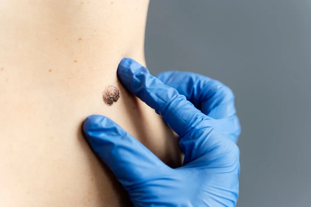 Mole Removal